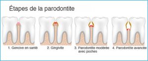 parodontite